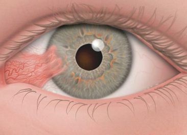 ناخنک چشم (Pterygium)