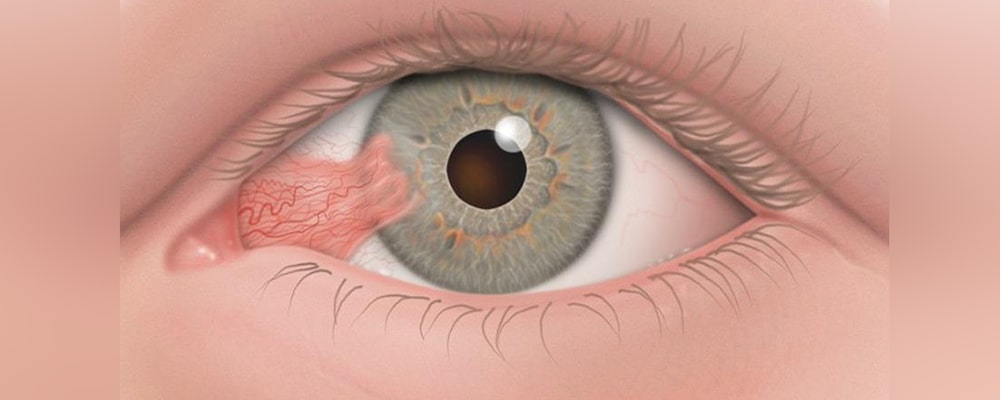 ناخنک چشم (Pterygium)