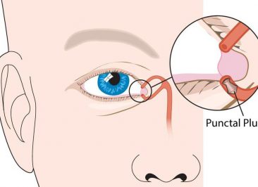 پلاگ های پونکتوم (Punctual plugs)