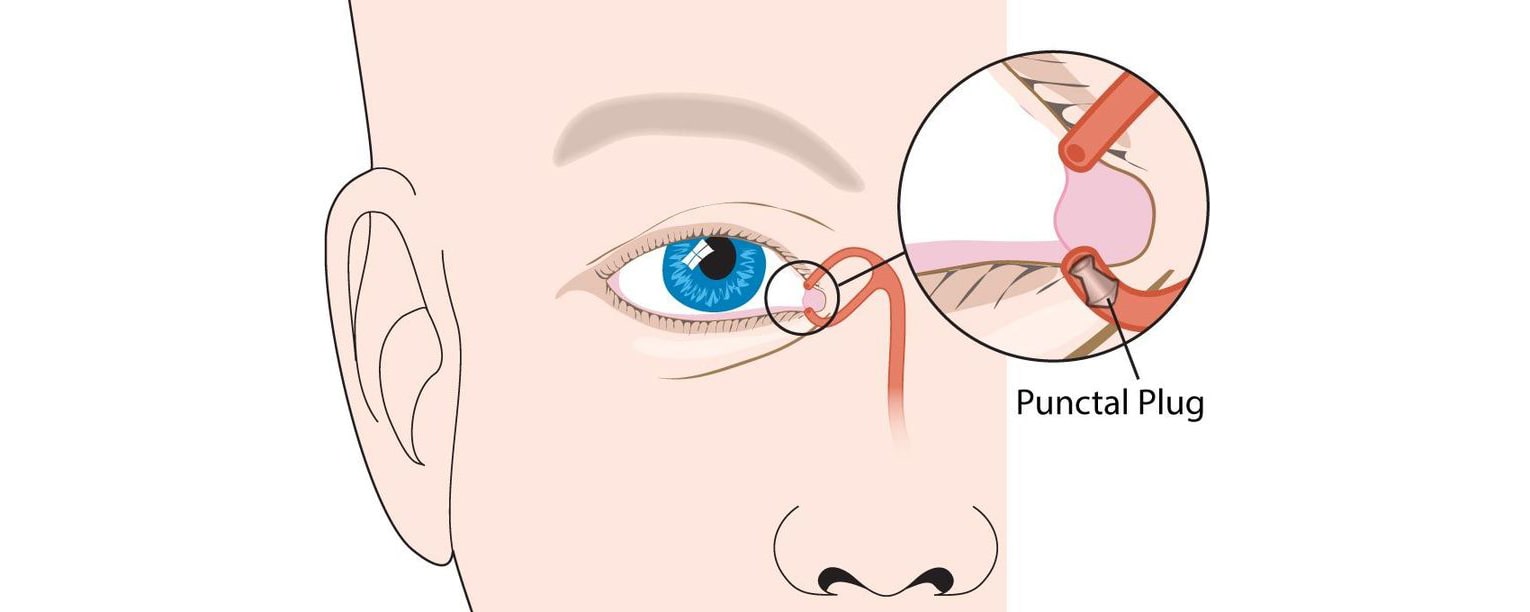 پلاگ های پونکتوم (Punctual plugs)