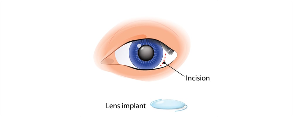 جراحی کاشت لنز ثانویه (Secondary lens implantation)