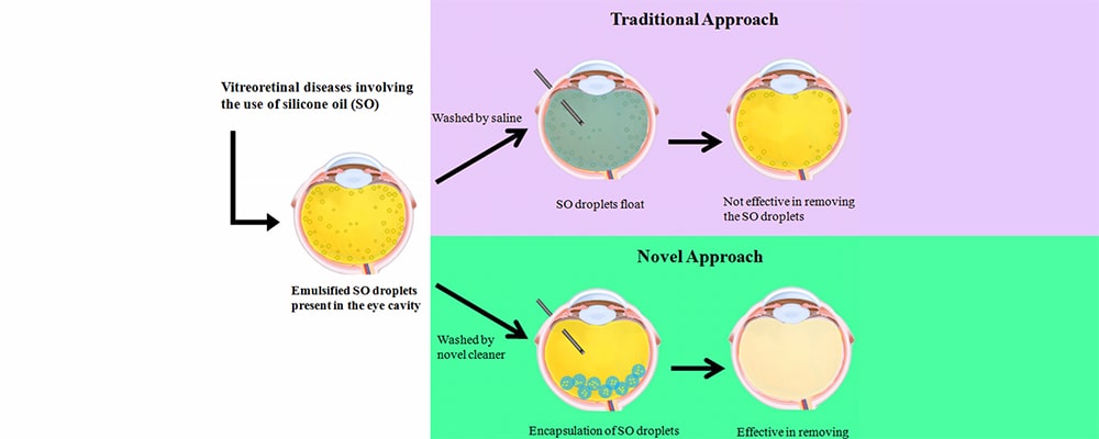 تزریق روغن سیلیکون برای جدا شدگی شبکیه