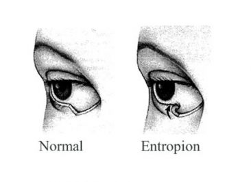 آنتروپیون (Entropion)