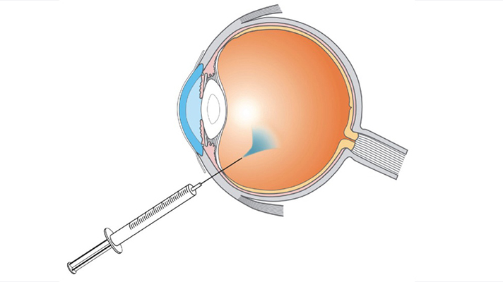 جراحی تزریق چشمی (اینتراویترال)