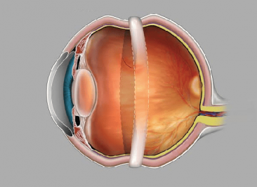 جراحی اسکلرال باکلینگ چشم (Scleral buckling)