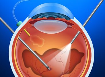 جراحی ویترکتومی (Vitrectomy)