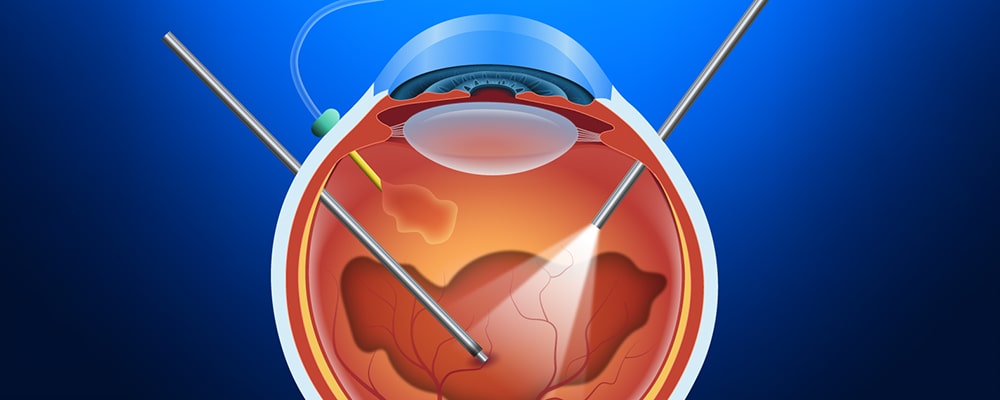 جراحی ویترکتومی (Vitrectomy)