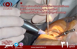 بررسی دو روش ۱،۸ ميلي متري micro–incision و ۲،۷۵ ميلي متري standard incision