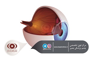 تازه‌های چشم‌پزشکی / بررسی یک مطالعۀ مولتی سنتر بین المللی پیامدهای کلینیکی حاصل از تعبیۀ یک لنز داخل چشمی با دید گسترده