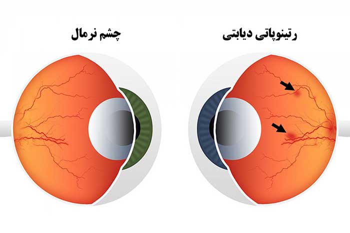 دیابت و تاثیر آن در چشم