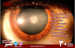 تشريح پوزيشني براي Phacoemulsification